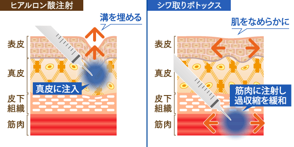 ボトックスの効果について