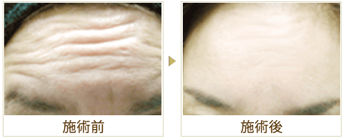 額のシワの症例写真