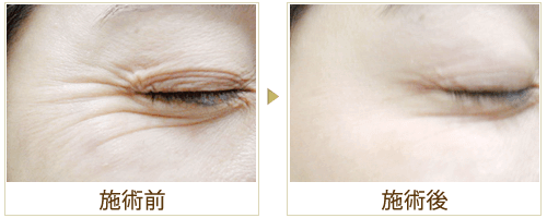 目尻のシワの症例写真