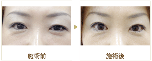 瞳ぱっちりの症例写真