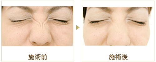 鼻の横ジワの症例写真