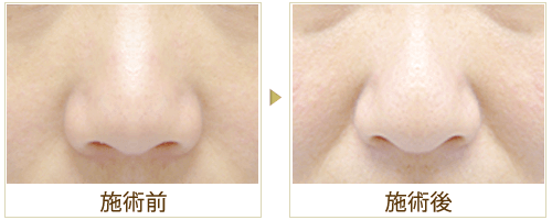 小鼻ボトックスの症例写真