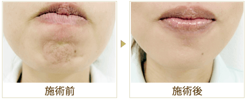 顎ボトックスの症例写真