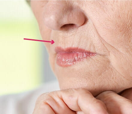 鼻の下の縦ジワ