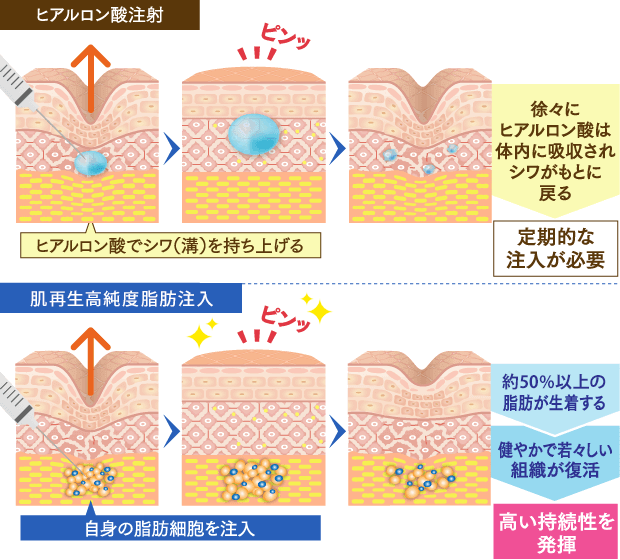 肌再生高純度脂肪注入のイメージ