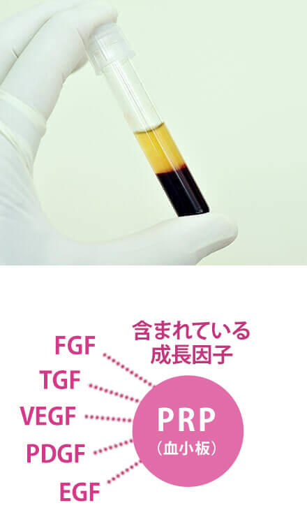 肌再生高純度脂肪注入＋PRP皮膚再生療法のイメージ
