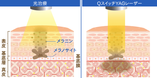光治療のQスイッチYAGレーザーの違い