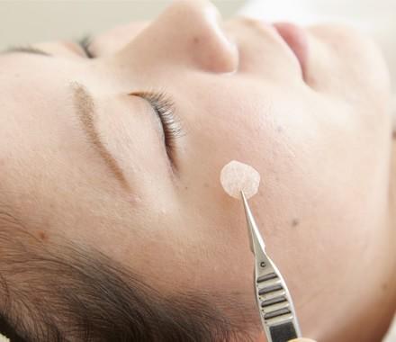 QスイッチYAGレーザー後のテープ保護