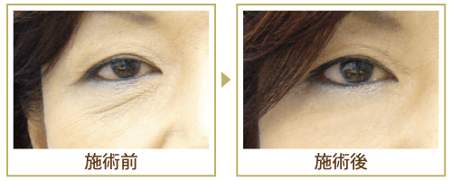 PRP皮膚再生療法の効果