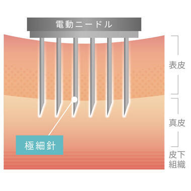 肌管理毛穴スリークスキン（ダーマペン4）の痛みやダウンタイム、リスクは？