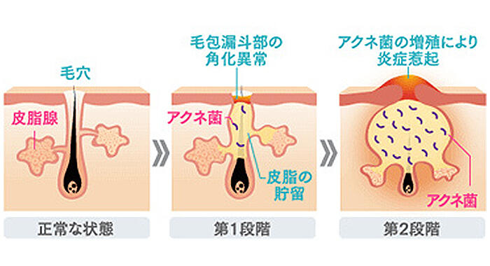 そもそもニキビができる原因って？