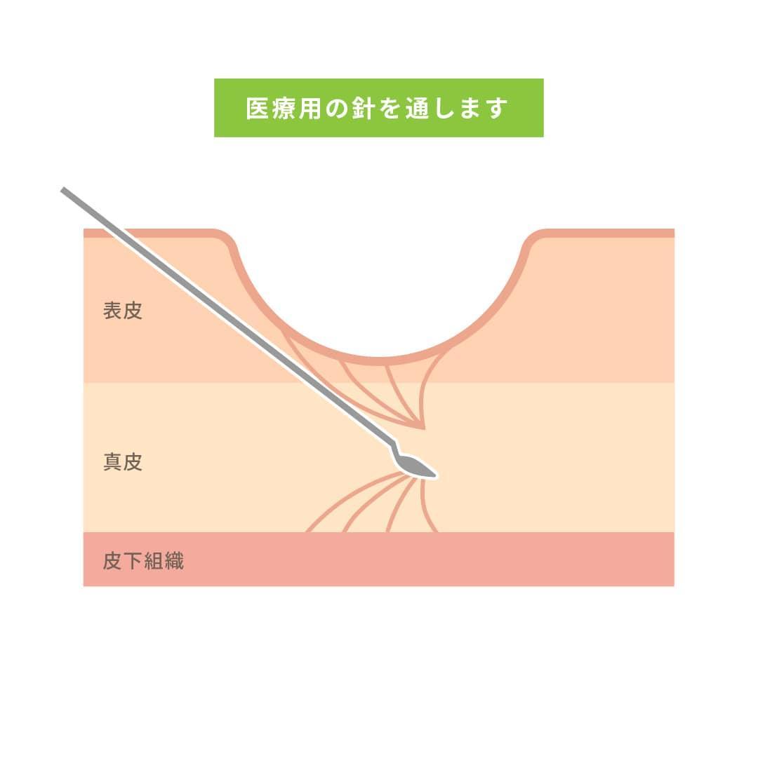 凸凹ニキビ跡やクレーターに効果的？サブシジョンとは