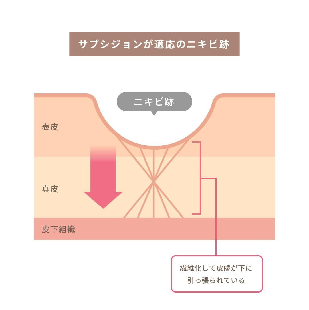 サブションが適応されるニキビ跡