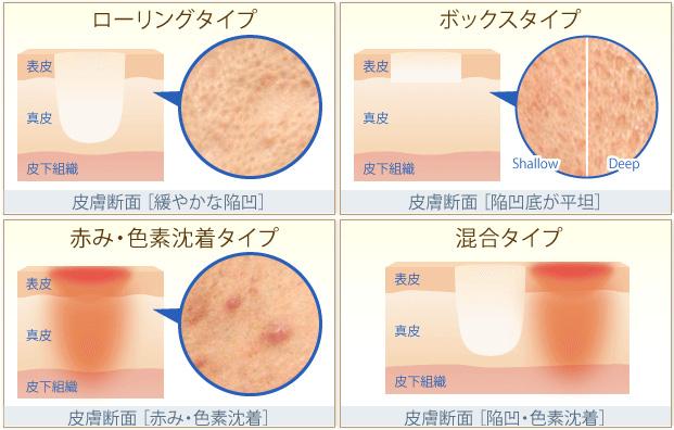 重度の凹凸ニキビ跡におすすめの治療