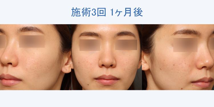 フラクシルリーフレット