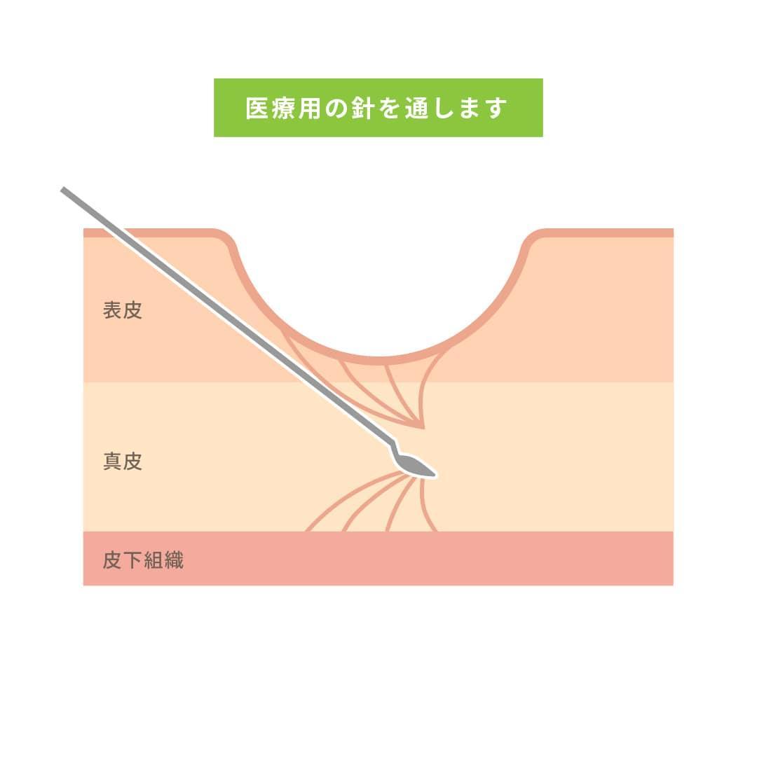 サブシジョン