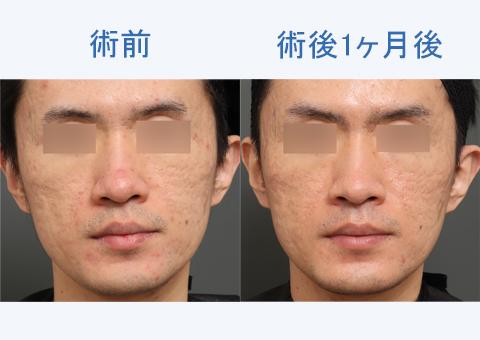 ニキビ跡改善！キュアジェット（ニキビ跡）の施術直後の写真～1ヶ月後の経過をご紹介！