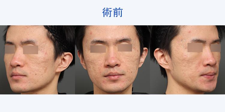 キュアジェット（ニキビ跡） 術前写真