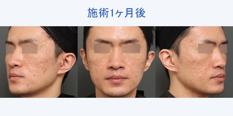 キュアジェット（ニキビ跡） 施術1ヶ月後
