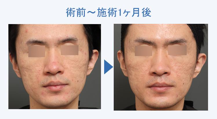キュアジェット（ニキビ跡） 術前術後の比較1