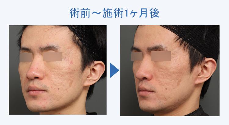 キュアジェット（ニキビ跡） 術前術後の比較2