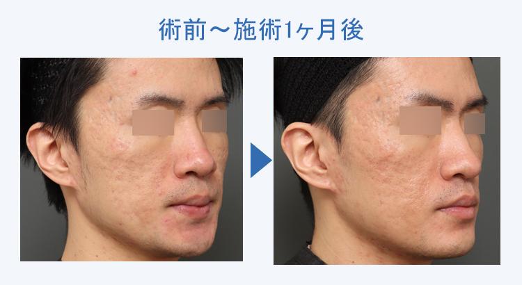 キュアジェット（ニキビ跡） 術前術後の比較3