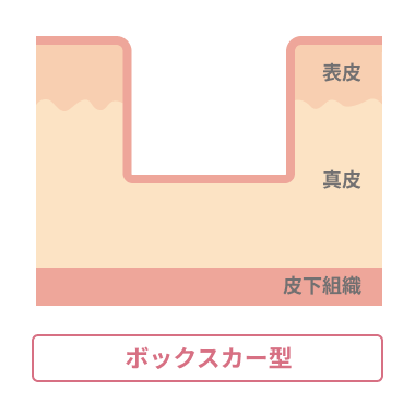 「マイクロサブシジョン」が効果的なニキビ跡の種類