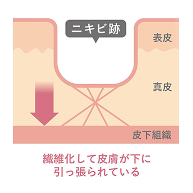 「マイクロサブシジョン」が効果的なニキビ跡の種類
