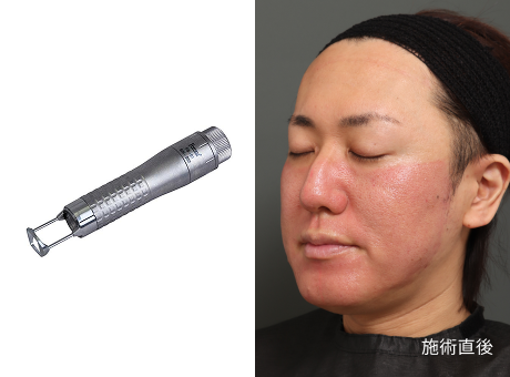 ニキビ跡治療にはFotonaフラクショナルレーザーが効果的！ダウンタイムや過ごし方も解説