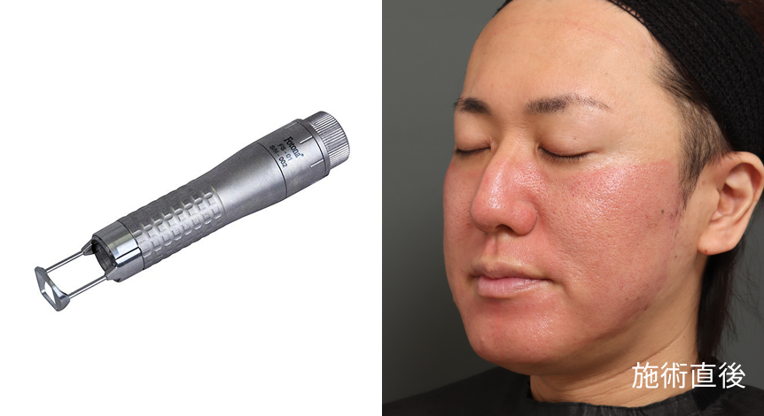 Fotonaフラクショナルレーザーのダウンタイム経過と過ごし方