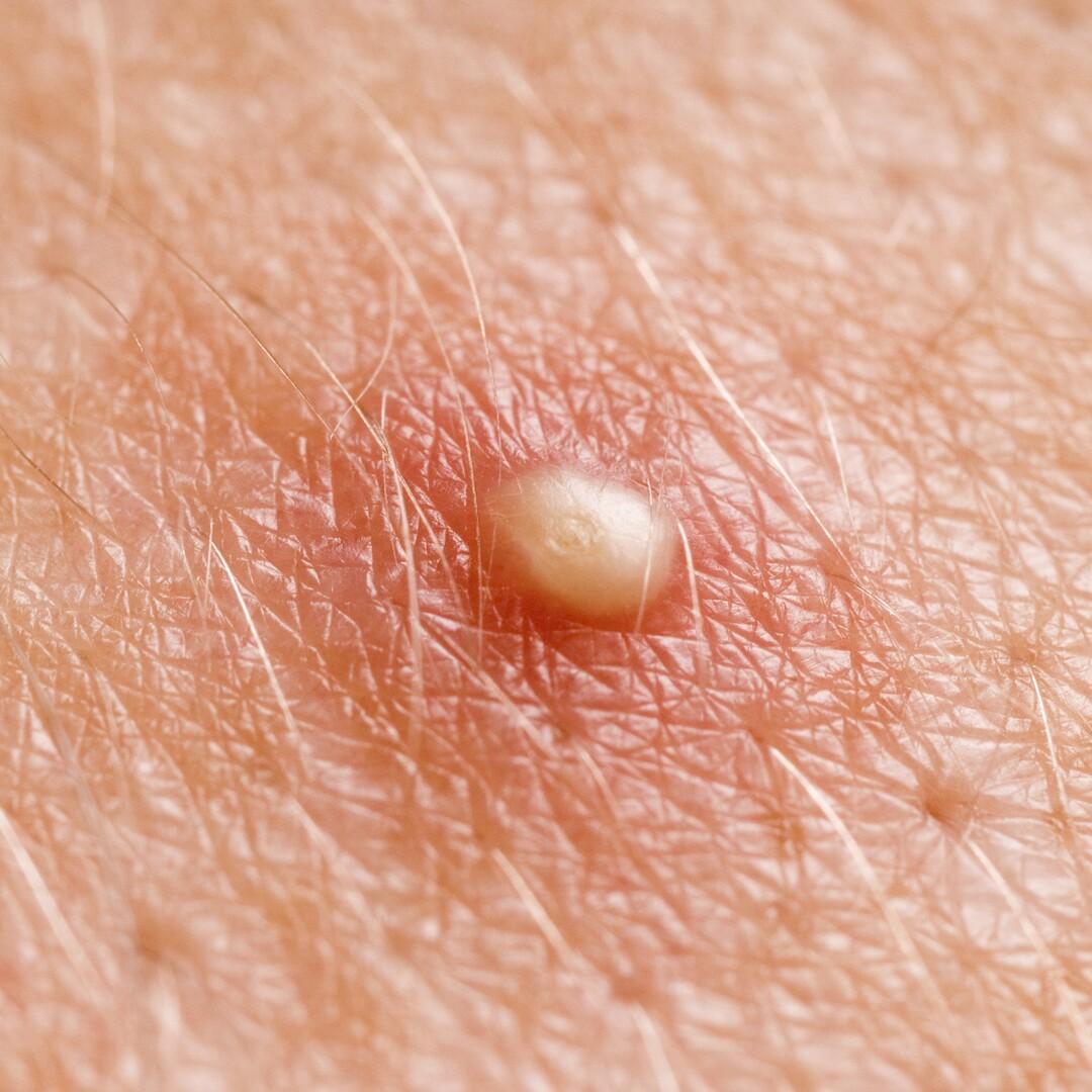ニキビ菌・炎症が進行している