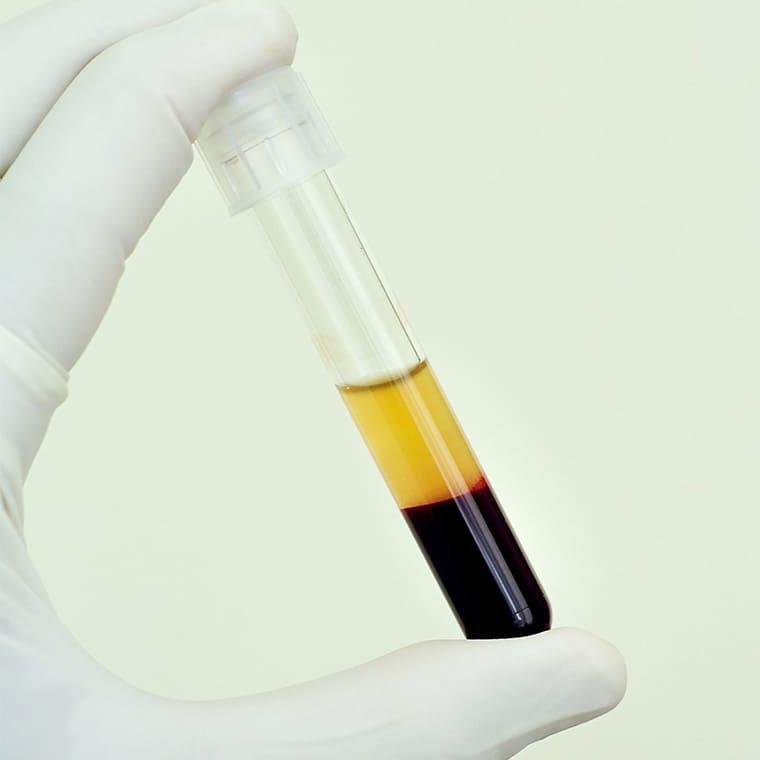 首のシワをなくす治療4:PRP皮膚再生療法