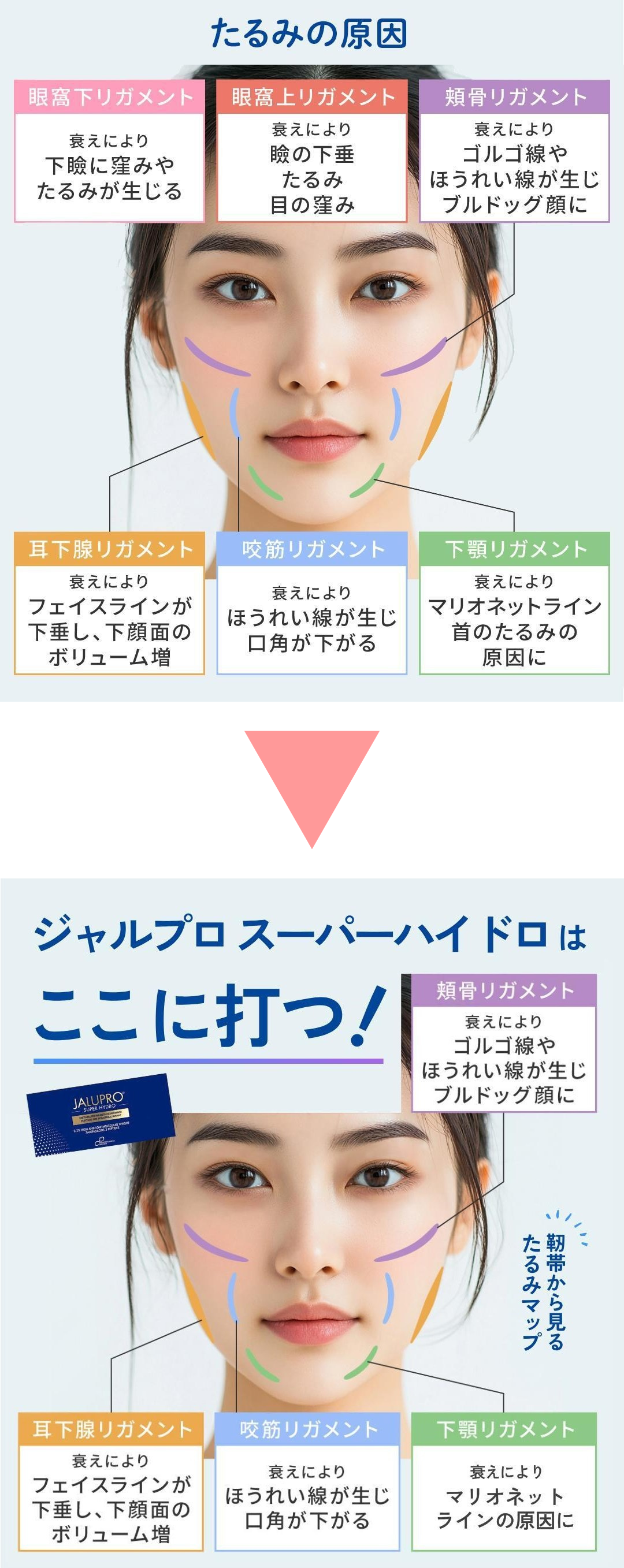 ジャルプロスーパーハイドロの打つ場所は?