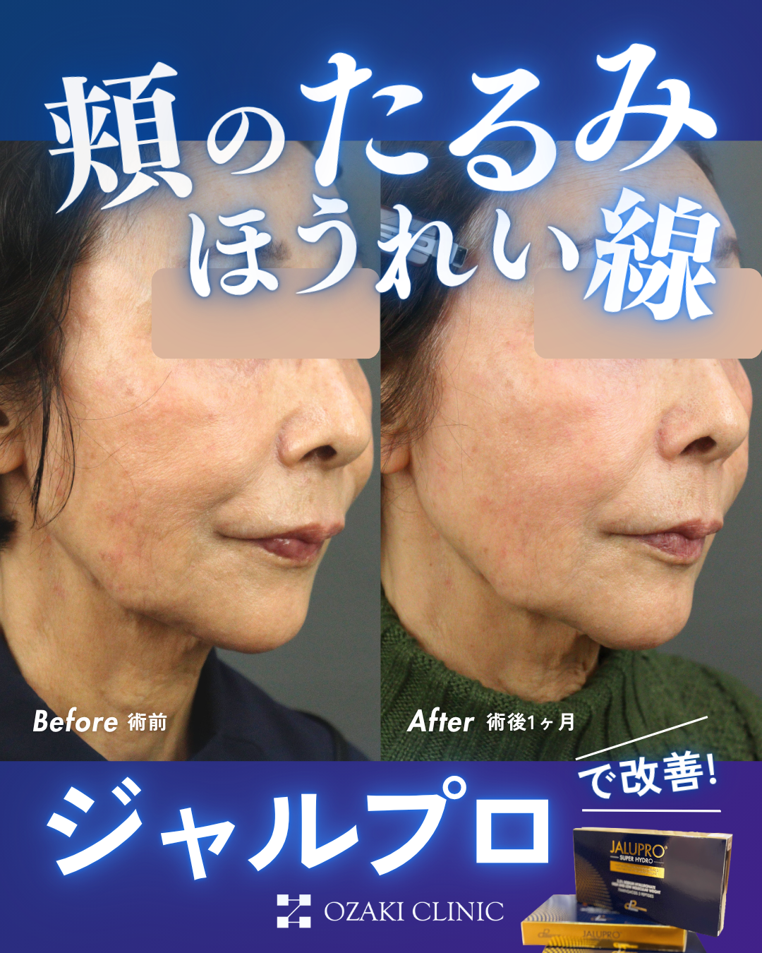 【症例紹介①】 肌の引き締まり・リフトアップ