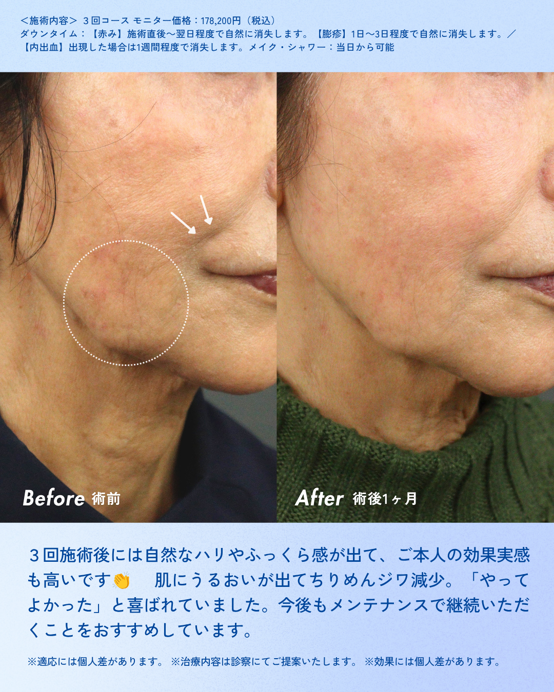 【症例紹介①】 肌の引き締まり・リフトアップ