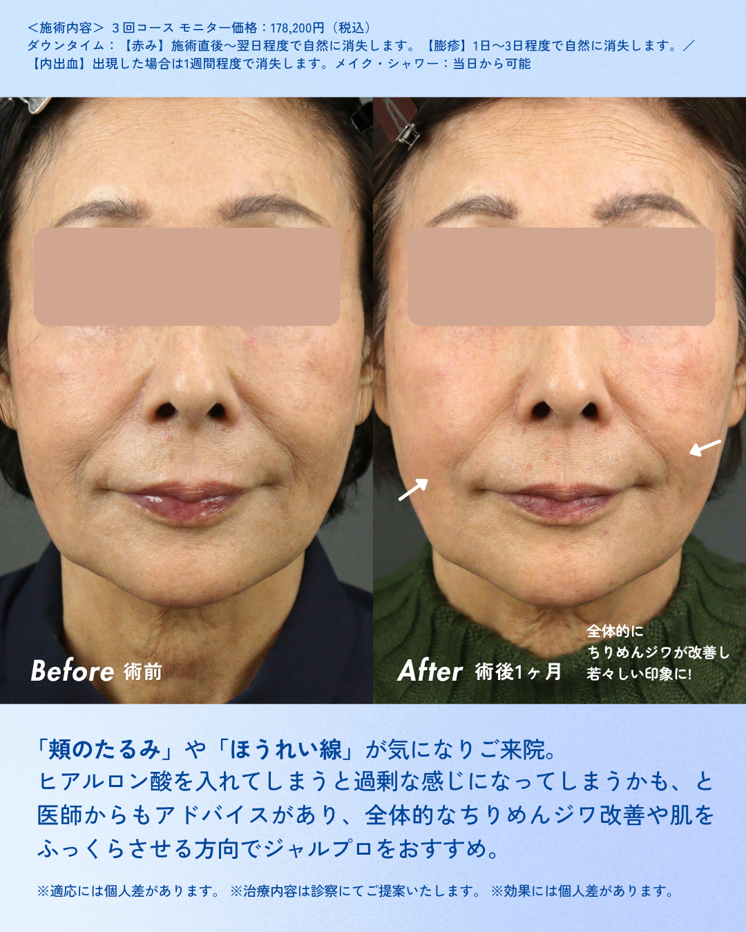 【症例紹介①】 肌の引き締まり・リフトアップ