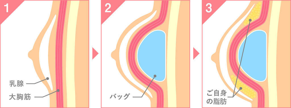 当院がおこなうハイブリッド豊胸のこだわり
