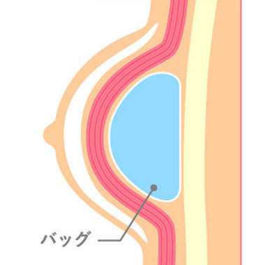 痩せ型の方が豊胸バッグによる豊胸をおこなう場合のリスク1：バッグの不自然な形が目立ちやすい