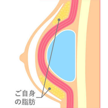 ハイブリッド豊胸とは？