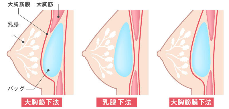 バッグの挿入箇所は主に「大胸筋下法」「乳腺下法」「大胸筋膜下法」の3つ