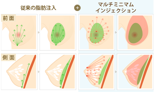 マルチミニマムインジェクション