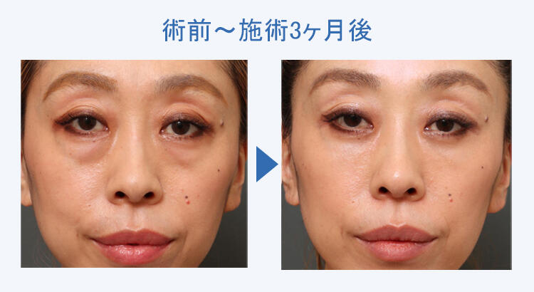 3Dリポアイリフト+裏ハムラ法 術前術後の比較1