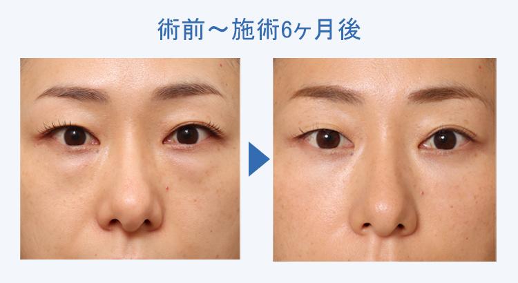 【40代女性ご相談】目の下の膨らみ・クマ改善｜3Dリポアイリフト+裏ハムラ法6ヶ月経過