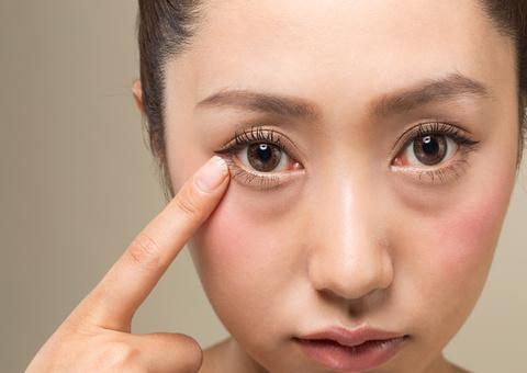 目の下の脱脂術のダウンタイム徹底解説｜痛み・内出血・腫れの経過をわかりやすく解説
