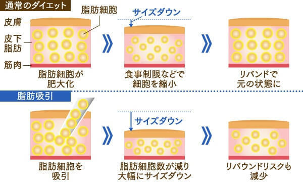 二の腕は、脂肪吸引が圧倒的におすすめ！