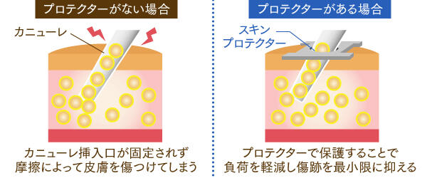 専用ツールで、傷跡を最小限に