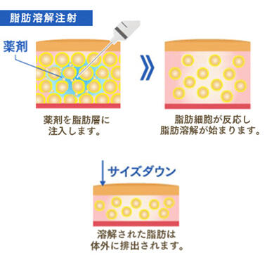 脂肪溶解注射のメリット