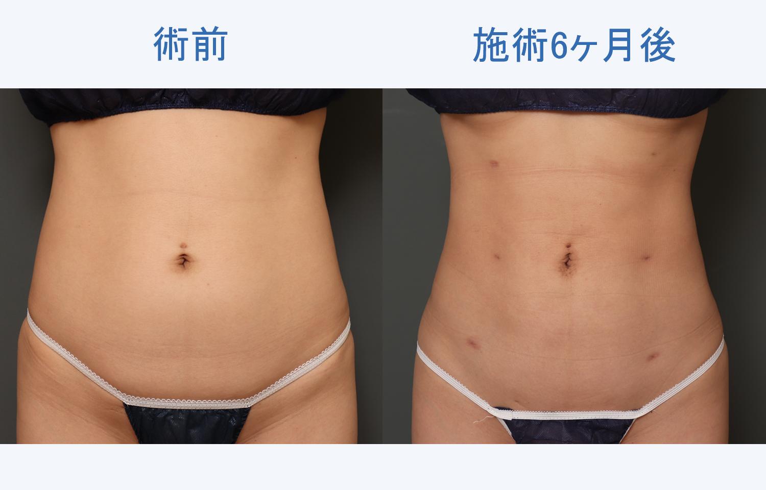 腹部全周+腰+背中の脂肪吸引とボディタイトの6ヶ月後の経過をご紹介！