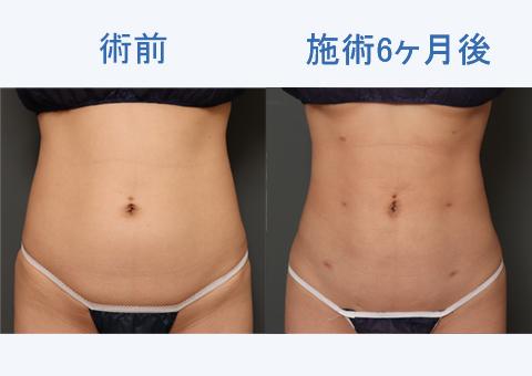 腹部全周+腰+背中の脂肪吸引とボディタイトの6ヶ月後の経過をご紹介！