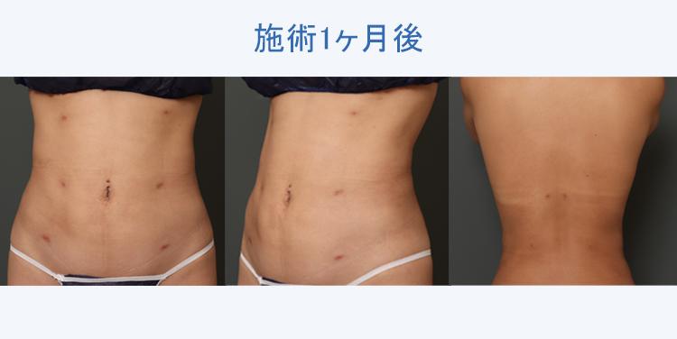 腹部全周+腰+背中の脂肪吸引+ボディタイト 施術1ヶ月後の症例写真